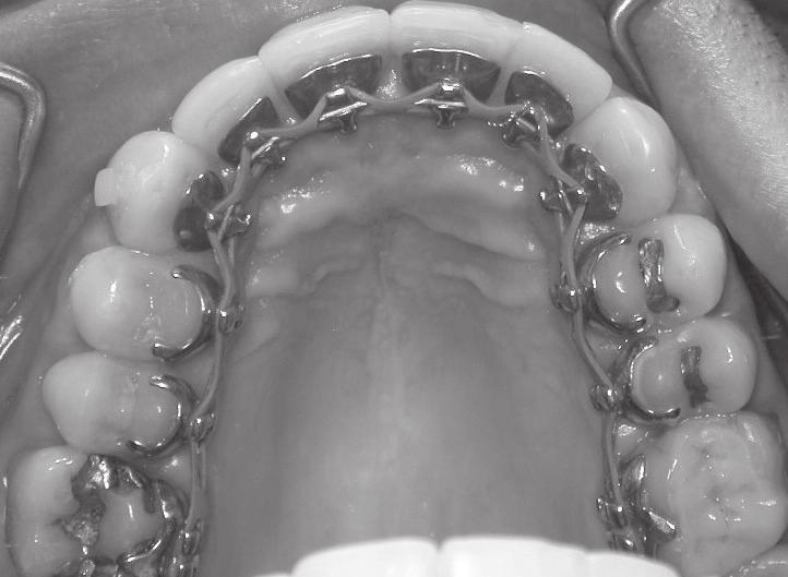 Conforto oral na ortodontia lingual 705 Figura 9 Vista oclusal do arco superior com os bráquetes individualizados de última geração confeccionados em ouro Figura 10 Em detalhe os bráquetes nos
