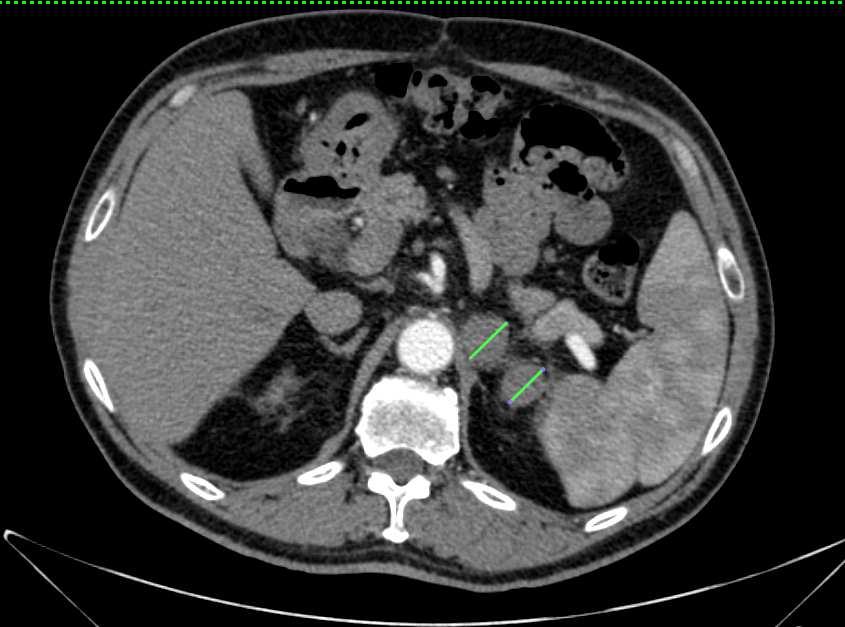 Lesão adrenal à