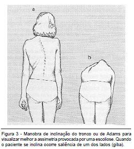 Inspeção lateral p/ lordose cervical e lombar e cifose dorsal (p/acentação ou retificação) O exame pelas laterais verifica,principalmente,as curvaturas da coluna, o