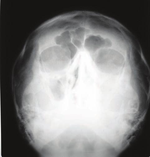 Caso Acidente/Complicação/ Anomalia dentária Região Radiografia Imagem radiográfica 1 Parestesia 47 PN Proximidade com nervo alveolar inferior 2 Parestesia 43 PN, PP, O odontoma composto 3
