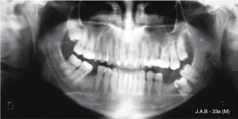 Importância do reconhecimento da anatomia radiográfica dentomaxilar na prevenção de complicações cirúrgicas O nervo e vasos alveolares inferiores caminham juntos no canal mandibular.