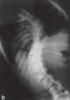 C e D) Radiografias pós-operatórias em AP e perfil, evidenciando boa correção. E e ) Radiografias com 2 meses de pósoperatório.