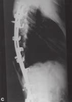 técnica, associada ao aprimoramento dos implantes e instrumentais utilizados, que facilitam a realização do procedimento cirúrgico.