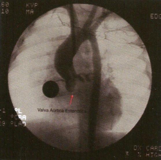 Aortografia por via carotídea.