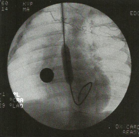 Valvoplastia aórtica por via carotídea.