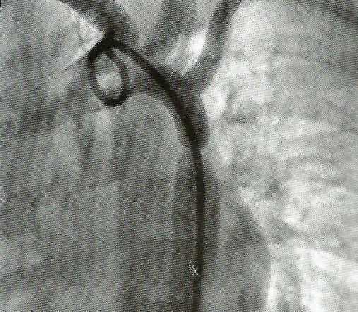 Aortografia mostrando