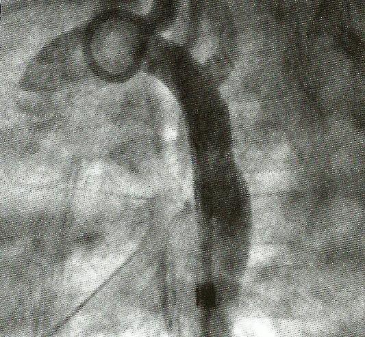 Aortografia