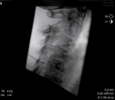 Figura 1-1 Radioscopia da região cervical com a agulha