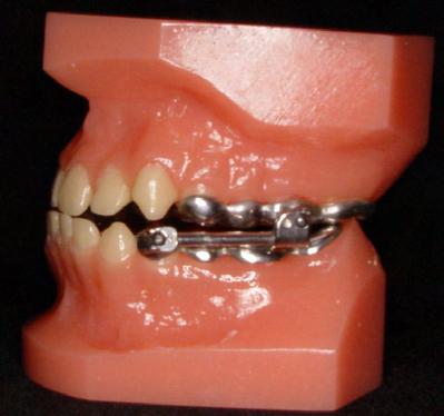 O avanço mandibular foi realizado de duas formas, avanço único e seqüencial.
