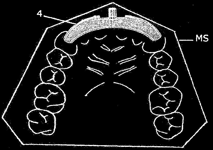 niple de topo-mandril polido (18), dito pino-trava (9) que se retrai com o movimento ascendente do pistão de liberação (5), e um retentor de trava (41).