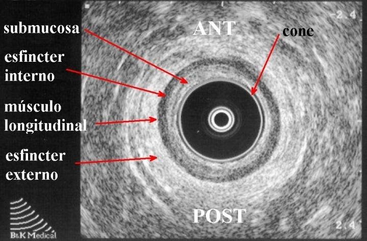 Figura 4 - Ultrassonografia endo-anal mostrando regiões anatômicas
