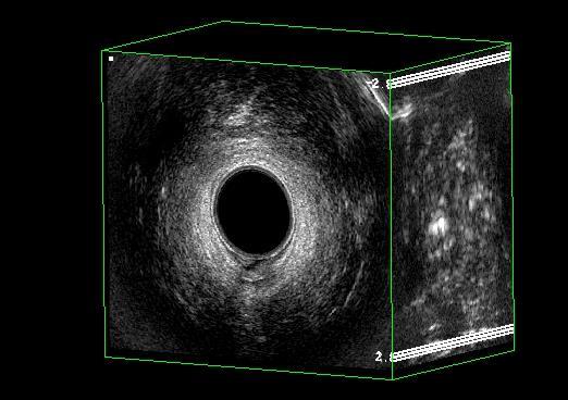 Figura 3 Imagem volumétrica digitalizada anterior direito esquerdo proximal posterior distal 3.6.3.1 Parâmetros avaliados a) Os índices biométricos do hiato urogenital ou hiato dos levantadores ultrassonográfico, incluindo os diâmetros ântero-posterior e látero-lateral além da área.