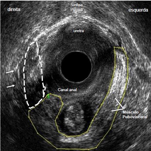 Figura 5 Imagem ultrassonográfica endovaginal em paciente com lesão parcial direita do músculo pubovisceral