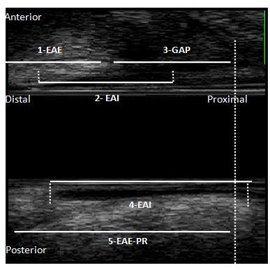 Figura 6 Parâmetros ultrassonográficos do canal anal (plano sagital) 1-comprimento do esfíncter anal externo (EAE) anterior, 2- comprimento do esfíncter anal interno (EAI) anterior, 3-