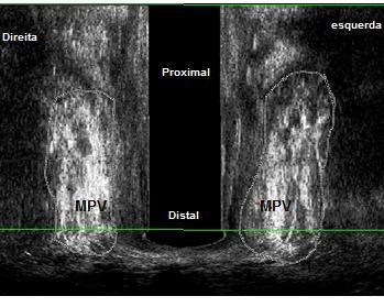 Figura 11 Ultrassonografias endovaginais 3D no plano coronal demonstrando ausência de lesão e presença de lesão no músculo pubovisceral a MPV: Músculo pubovisceral. a- ausência de lesão do MPV.