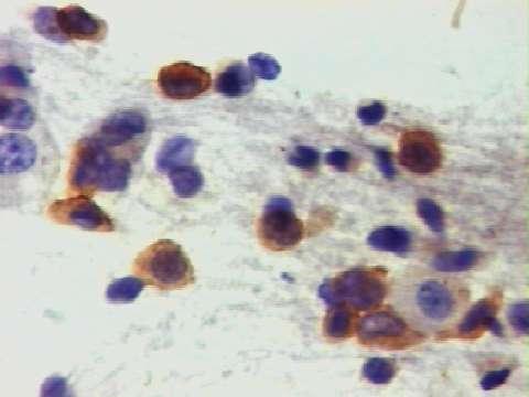 Histiocitose de células de Langerhans Anticorpo