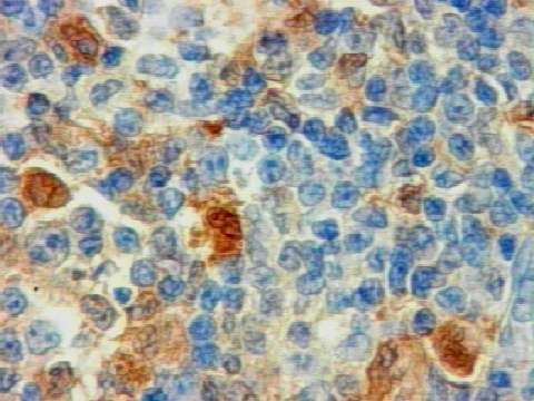 Histiocitose de células de Langerhans
