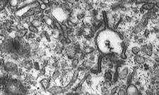 Histiocitose de células de Langerhans Diagnóstico definitivo: Exame anatomopatológico com reconhecimento morfológico das células de Langerhans em microambiente apropriado (número variável de