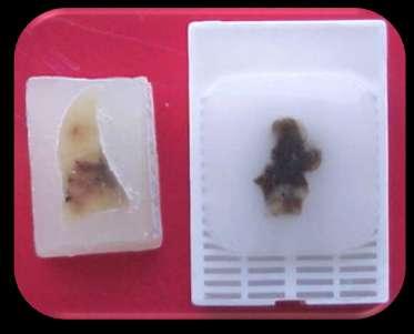 Imuno-histoquímica IHQ em material fixado em formol e incluído em parafina ð Método de escolha Vantagens: material coletado, fixado e processado convencionalmente: biópsias incisionais e