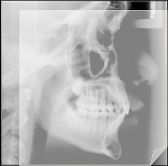 25 Figura 2 - Papel ultraphan sobreposto a radiografia 4.