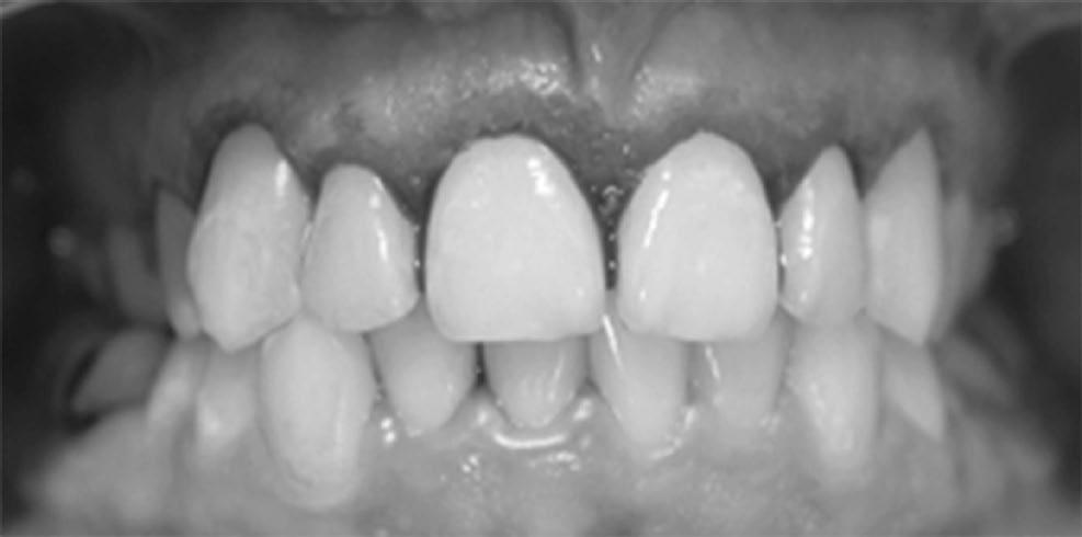 Figura 4 Transcirúrgico nos dentes 21, 22 e 23 Figura 5 Pós-cirúrgico imediato nos dentes 11, 12, 13, 21, 22 e 23.