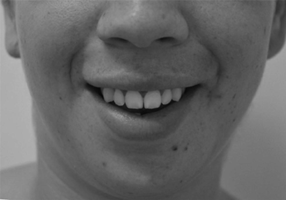 Figura 8 Resultado estético aproximado: deiscência uniforme do lábio superior.