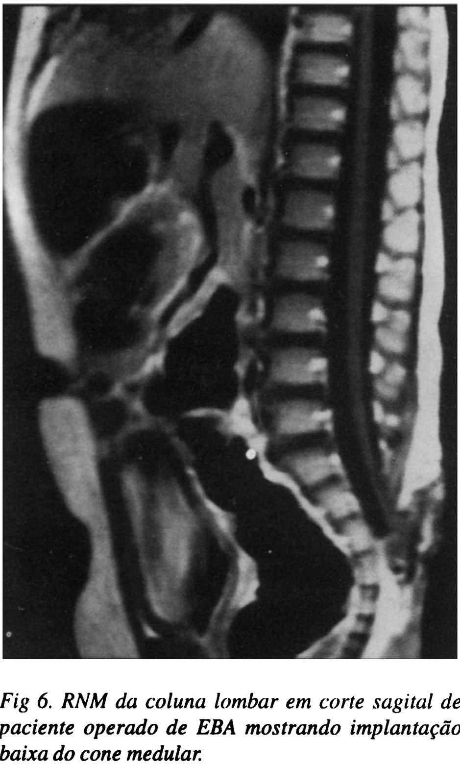 das causadas por lipomas e pela diastematomielia 3.