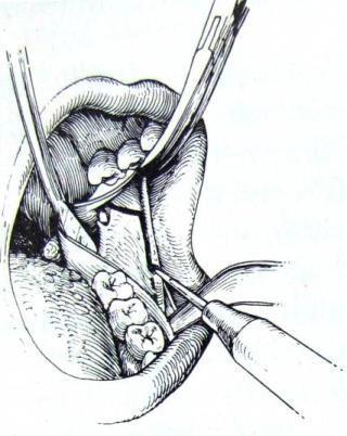 14 deslocamento do ligamento pterigomassetérico e do periósteo para proporcionar melhor vascularização aos segmentos da osteotomia. Figura 1 Osteotomia Sagital segundo Epker (1977).