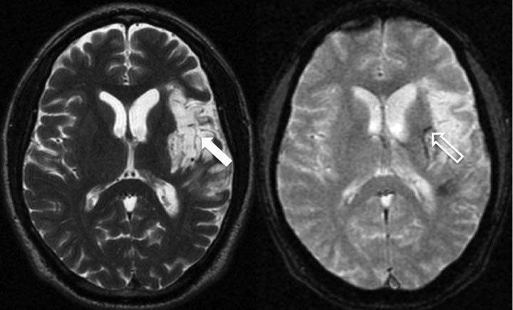 35 Figura 1- Imagens de ressonância magnética no plano axial (A - ponderada em T2 e B - gradiente refocalizado eco) de um paciente masculino de 55 anos, onde se observa uma área de malácia secundária