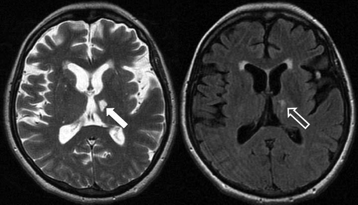 38 Figura 2 Imagens de ressonância magnética no plano axial (A ponderado em T2 e B fluid atenuated inversion recovery FLAIR), de paciente feminino de 62 anos, com diminuta área de malácia no tálamo