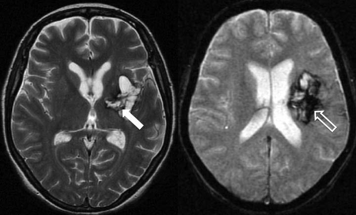 40 Figura 3 Imagens de ressonância magnética no plano axial (A ponderada em T2 e B gradiente refocalizado eco) de paciente feminino de 48 anos com área de malácia (seta) preenchida por produtos de