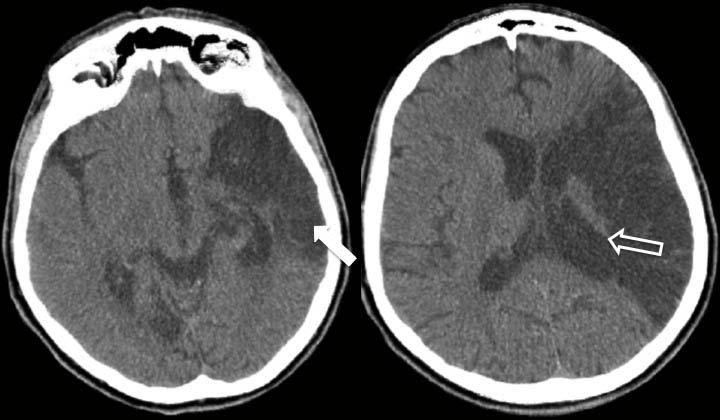 42 Figura 4 Imagens de tomografia computadorizada no plano axial, de paciente masculino de 51 anos, com áreas de malácia (seta fechada) por isquemia no território da ACM esquerda, com retração do