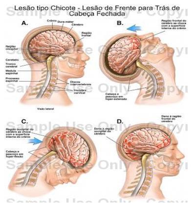 2.1.4. Capotamento Lesões esperadas: Lesões variadas derivadas dos diferentes impactos sofridos; Lesões de órgãos internos mesmo com uso de restritores de segurança; Ejeção.