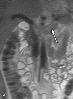 1 Trombose da Veia Renal Fig. 1.12a,b Trombose da veia renal esquerda. O trombo dilata a veia renal esquerda, que cruza diante da aorta (seta em a).