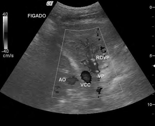 Os fluxos nos vasos apresentam sentidos opostos, hepatopetal no ramo portal e hepatofugal na veia hepática. FIGURA 10.