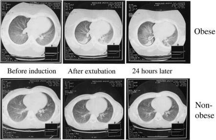 Anesth Analg 2002;95:1788 92 Efeitos da PEEP Não obeso PEEP Obeso PEEP ZEEP ZEEP Obesidade diminui a