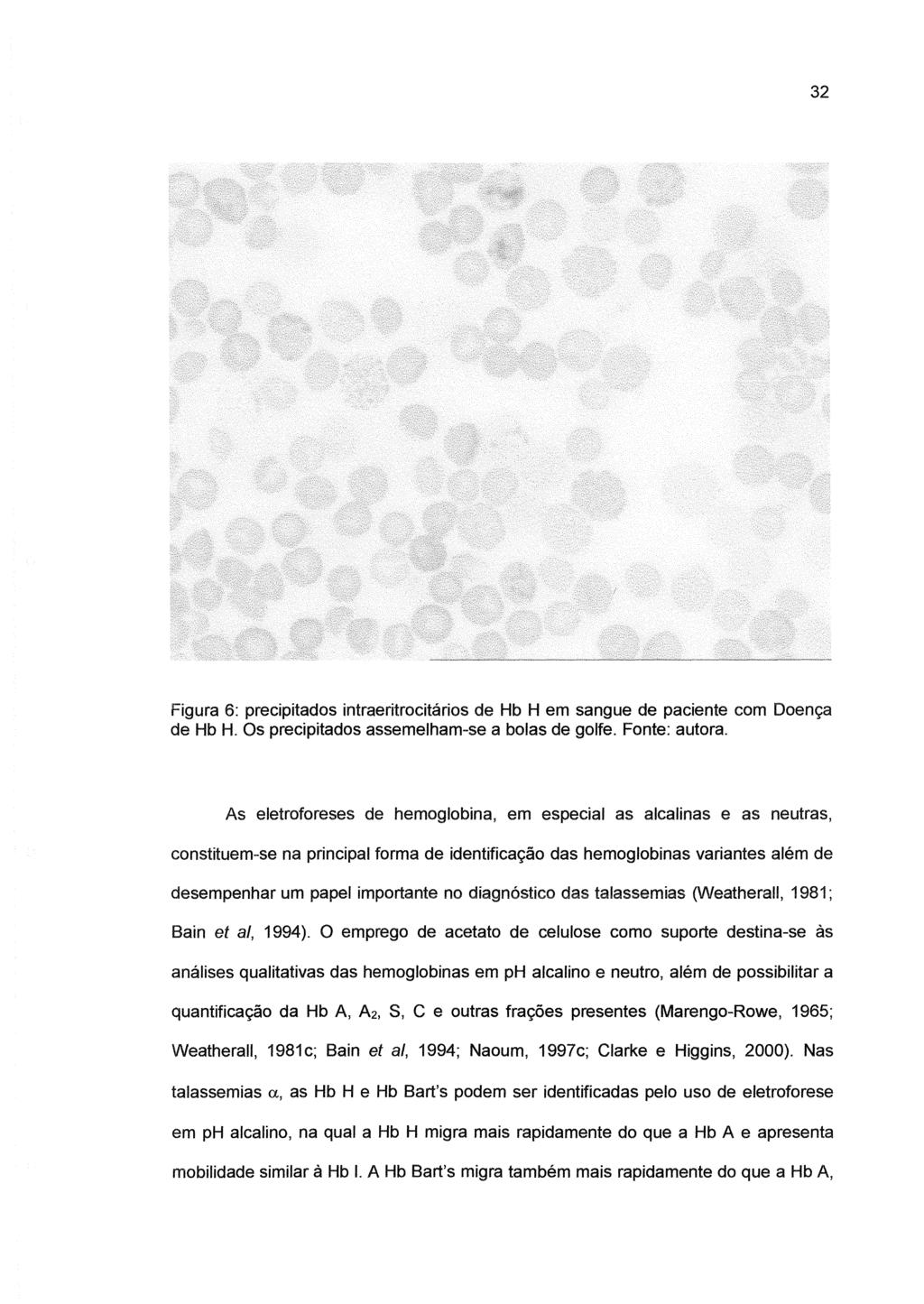 32 Figura 6: precipitados intraeritrocitários de Hb H em sangue de paciente com Doença de Hb H. Os precipitados assemelham-se a bolas de golfe. Fonte: autora.