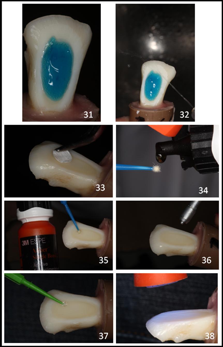 Figura 31 Condicionamento com ácido fosfórico 37%. / Figura 32 Lavagem do ácido fosfórico 37% realizado com água da seringa tríplice. / Figura 33 Secagem da dentina realizada com papel absorvente.