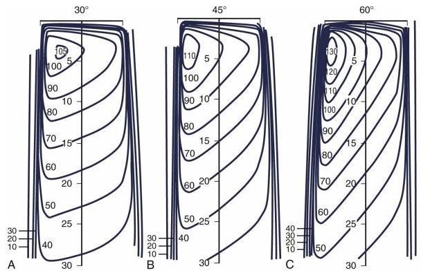 Filtros físicos produzindo curvas de isodose com inclinação de 15º, 30º, 45º e 60º são, geralmente, comprados do fabricante do aparelho de radioterapia [5]. Figura 5.