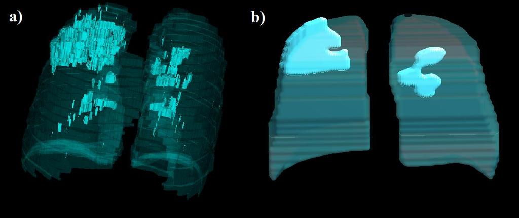 23 Figura 11 - Representação 3D dos pulmões com regiões de comprometimento a partir de exames de (a) Tomografia Computadorizada e (b) raios X de tórax. 5.