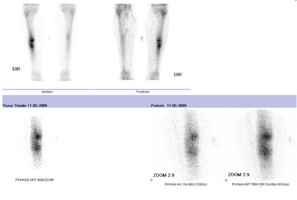 138 Revista Portuguesa de Ortopedia e Traumatologia Portuguese Journal of Orthopaedics and Traumatology INTRODUÇÃO O osteoma osteóide foi pela primeira vez descrito por Jaffe em 1935 como um tumor