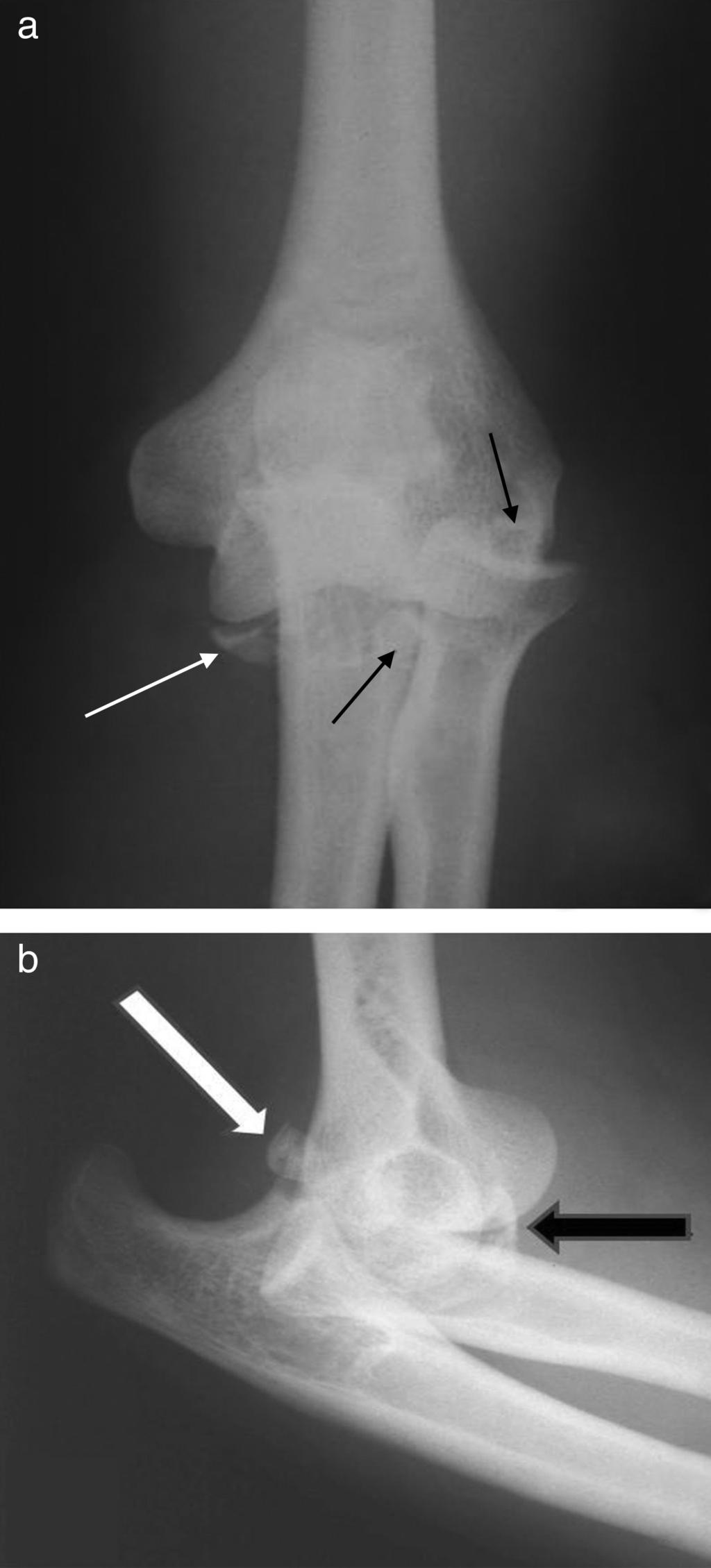 274 rev bras ortop. 2014;49(3):271 278 Figura 1 a Radiografia em AP do cotovelo esquerdo luxado (caso 10). Seta branca, fragmento da fratura do processo coronoide.