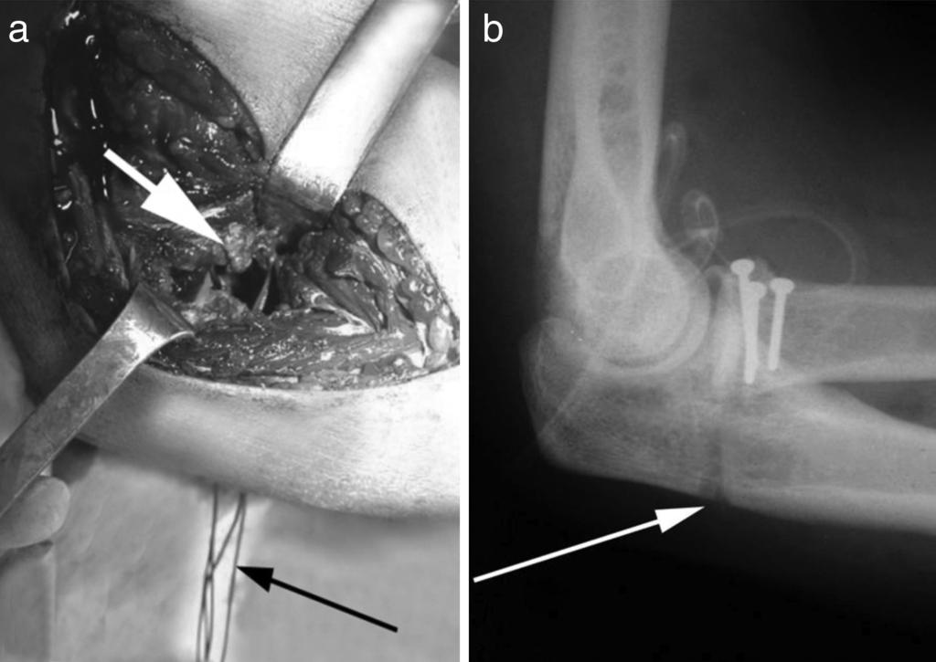 rev bras ortop. 2014;49(3):271 278 275 Figura 2 a Fotografia intraoperatória (cotovelo esquerdo; via medial).