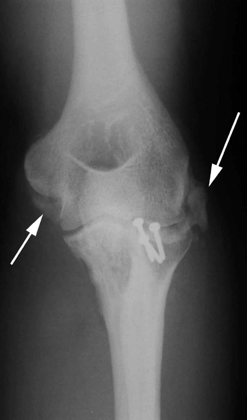 rev bras ortop. 2014;49(3):271 278 277 Figura 4 Radiografia em AP do cotovelo esquerdo (caso 10); pós-operatório de sete meses. Setas brancas, ossificação heterotópica.