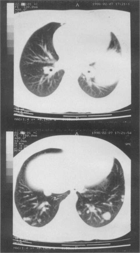 fúrcula. Ainda assim, a paciente não recebeu dose terapêutica de radioiodo, sendo mantida em quimioterapia.