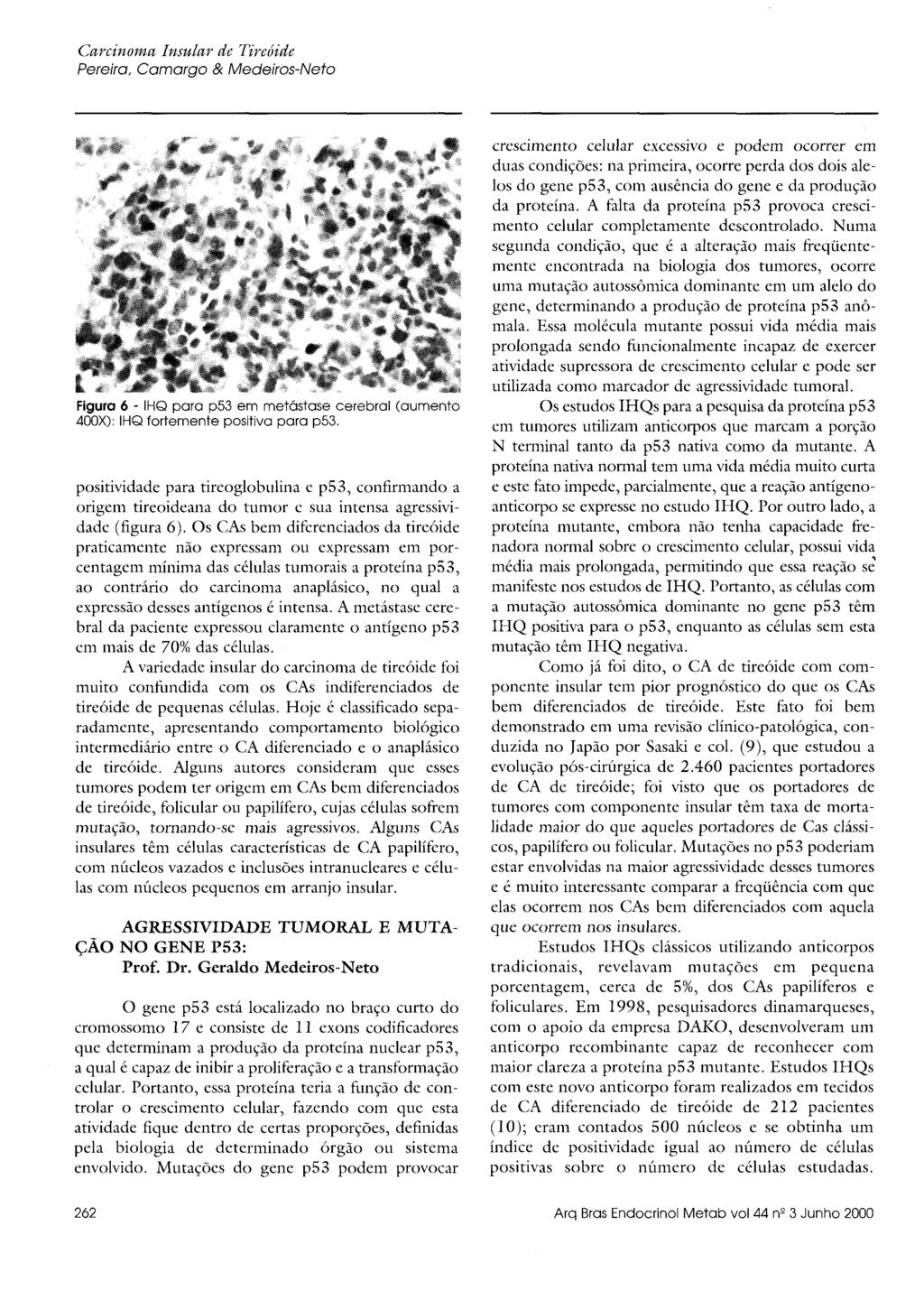 positividade para tireoglobulina e p53, confirmando a origem tireoideana do tumor e sua intensa agressividade (figura 6).