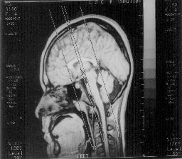 422 Arq Neuropsiquiatr 1998;56(3-A) Fig 1.