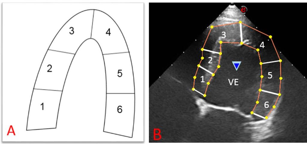 38 FIGURA 8 A e B: Identificação dos segmentos miocárdicos do ventrículo esquerdo (VE) no plano apical quatro câmaras.