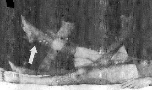 Coluna lombosacra Provas de estiramento da raiz nervosa Lasègue Técnica: flexão passiva da coxa sobre a