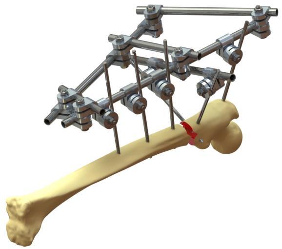 d) Descrição do princípio físico e fundamentos da tecnologia do produto: O Fixador Externo Tubo-Tubo é constituído por conectores (clamps), barras maciças e tubos.